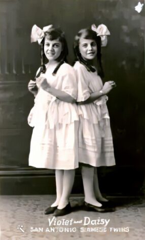 Siamilaiset kaksoset Daisy ja Violet Hilton (1900-luvun alkupuoli, Iso-Britannia)